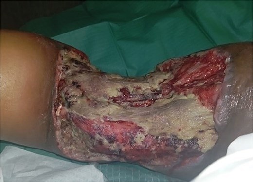 Image showing worsening wound with increased necrotic tissue.