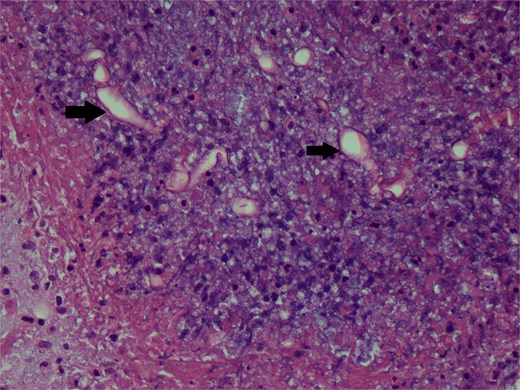 Hematoxylin and eosin stain photomicrograph showing fungal hyphae.