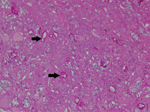 Periodic Acid Schiff stain photomicrograph showing broad-based aseptate fungal hyphae and spores (arrows).