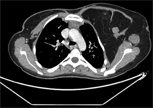 Interval increase in size of the large left upper lateral cervical, sub-pectoral, and axillary region fatty lesion protruding beyond the pectoralis major muscle into the upper breast region, keeping with lipomatosis.