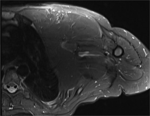 Left chest wall lipomatosis with extension to the left neck and left axilla with thin septations, and there is a small enhancing focus (within the fatty lesion) which could be a small enhancing nodule or lymph node. The overall measurement has relatively increased (consider patient maturation).