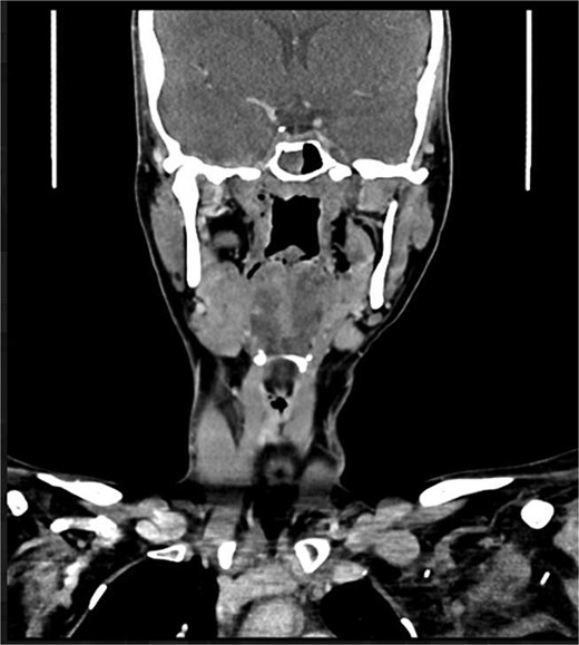 Partially scanned left thoracic lipomatosis extending to the lower neck with mild mass effect over the left internal jugular vein. A multilocular goiter with a complex thyroid nodule is noted in the lower neck.