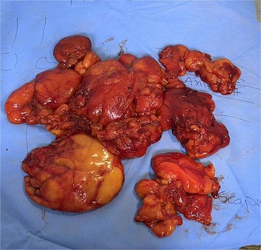 Multiple masses with fatty appearance (from neck, left axilla, and chest wall) ranging in size from 9.0 to 18.0 cm.