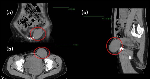 Pelvic computed tomography.