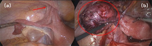 Surgical intervention.