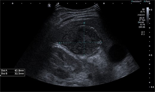 Abdominal ultrasonography imaging of pathological dense fluid collection adjacent to liver segment VI.
