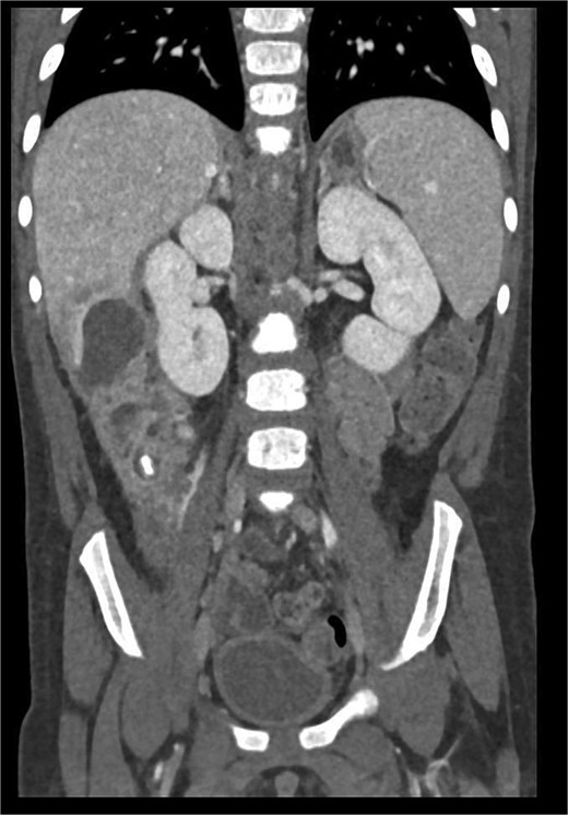 CT imaging of acute appendicitis with fecalith and multiple hepatic abscesses.