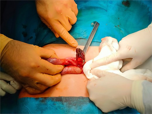 The gangrenous appendix revealed during surgery.