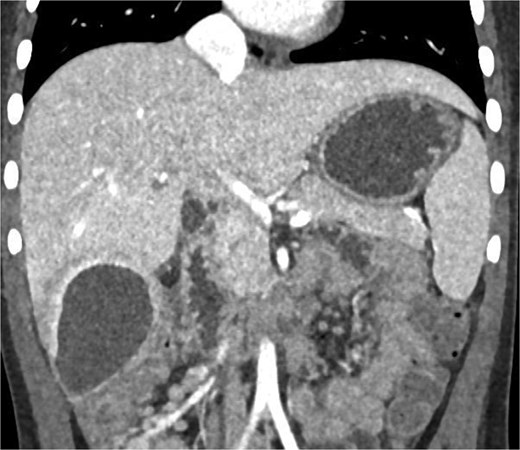 CT coronal view of a subhepatic abscess.