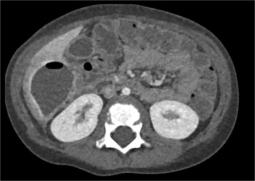 CT axial view of a subhepatic abscess. Contrast-enhanced capsule and fluid-air level visible.