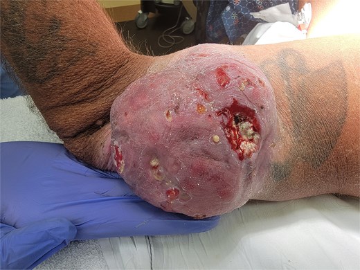 Left lateral elbow soft tissue mass, measures 11.5 × 9.5 × 4 cm.