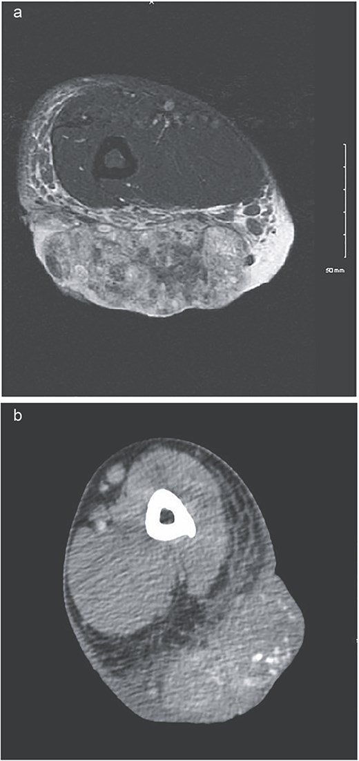 (a) MRI showing low signal on T1 and heterogeneously increased in signal on T2 sequences. Extensive surrounding subcutaneous edema with involvement of the dermal layer, as well as mild edema along the anterior fascia of the muscle. No definitive involvement of the muscle compartments noted, no involvement of neurovascular bundle. Some enlarged epitrochlear lymph nodes seen within the medial aspect of the elbow, with concern for possible local metastatic disease. (b) CT upper extremity demonstrating calcified arm lesion with vascularity supplied from branches of the proximal brachial artery. Involvement in the dermis and subdermal fat.
