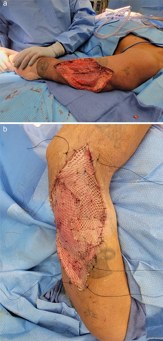 Left arm status-post surgical resection (a) followed by split-thickness skin graft application from anterior thigh donor site (b).