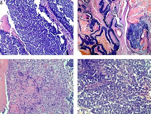 Histologic slides demonstrating basaloid cells (a), nests of basaloid and shadow cells (b), cytoplasm of ghost cells (c), shadow cells with basophilic granules (d).