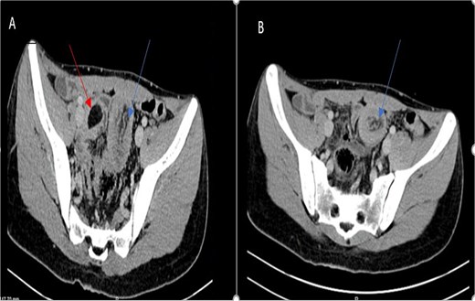 Axial CT scan showing an oval fat density mass representing a jejunal lipoma (A) and a telescoping intestine measuring 20 × 4 cm (B).