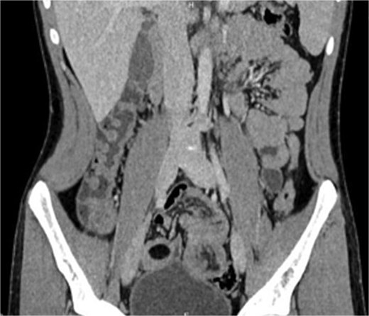 Coronal CT scan showing “sausage-shaped” mass.