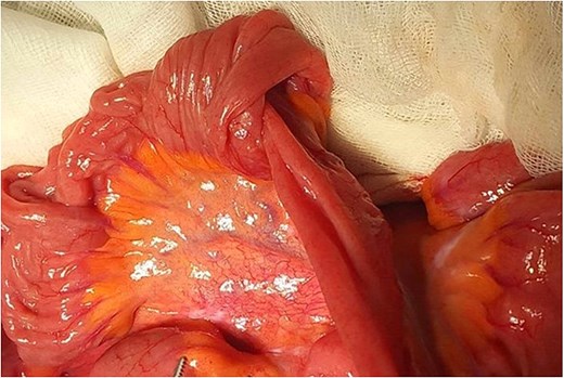 Preoperative view of compounded ileo-ileal intussusception.