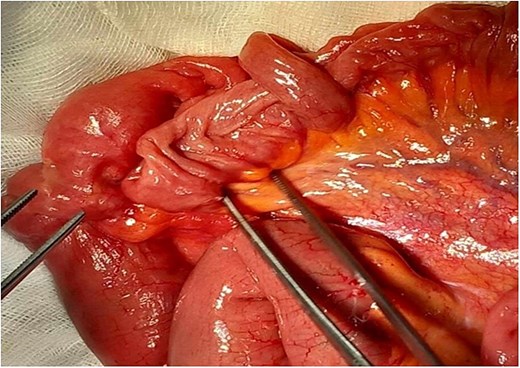 Preoperative view of manual reduction exposed a compound ileo-ileal intussusception without vascular compromise.