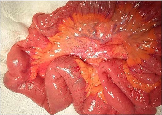 Preoperative view of submucosal lipoma.