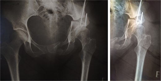 Postoperative anteroposterior radiographs of the pelvis, showing Pol Le Cœeur triple pelvic osteotomy performed on a 35-year-old female patient to treat an acetabular dysplasia in the left hip, at Grade 1 Crowe’s classification.