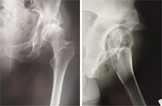Postoperative radiographs of the pelvis 20 years after pelvic osteotomy, showing signs of moderate osteoarthritis in the left hip (Tönnis Grade III), and radiographic evidence of acetabular retroversion (ischial spine sign and posterior wall sign).