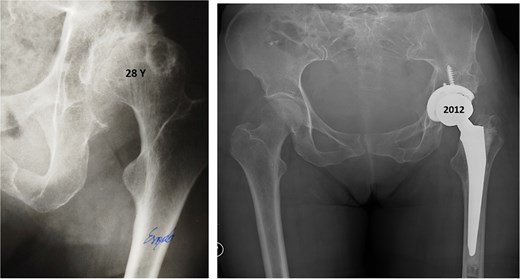 Anteroposterior radiographs of the pelvis 28 years after the pelvic osteotomy, showing advanced left hip osteoarthritis (Tönnis Grade V). A hybrid cemented total hip arthroplasty was implanted using a standard posterolateral approach.