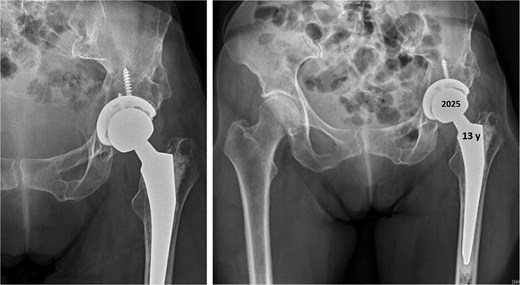 Postoperative anteroposterior radiographs of the pelvis 13 years after the THA, showing mechanical stability of the prosthesis with no evidence of loosening. No signs of osteoarthritis are present in the right hip (Tönnis Grade 0).