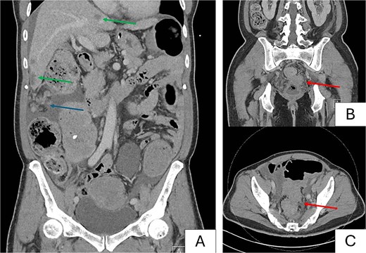 Preoperative computed tomography images. Images demonstrate a metastatic rectosigmoid mass with suspicious nodules in liver and peritoneum with features of large bowel obstruction. (A) Coronal image demonstrating bulky peritoneal nodules (blue arrow), and bilobar hepatic nodules suspicious for metastases (green arrows). (B) Coronal image demonstrating primary rectosigmoid tumor (red arrow). (C) Axial image demonstrating tumor with pericolonic nodules suspicious for nodal involvement (red arrow).