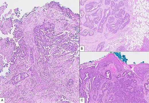 Microscopic views of intraoperative specimens (H&E, × 50). (A) Specimen from sigmoid tumour showing colonic tissue fragment with moderately differentiated invasive adenocarcinoma. (B) Tissue from omental nodule showing fibroadipose tissue with infiltrates of adenocarcinoma positive for CDX2. (C) Tissue from anal nodule with focal squamous epithelium showing infiltrates of adenocarcinoma with morphology comparable to specimens A and B.
