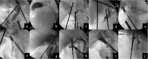 Images from intraoperative cholangiograms—(a) Case 1, (b) Case 2, (c) Case 3, (d) Case 4, (e) Case 5, (f) Case 6, (g) Case 7, (h) Case 8, (i) Case 9, and (j) Case 10.