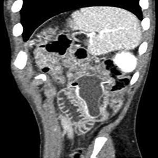 CT sagittal view showing fluid-filled nipple of feeding bottle lodged in jejunum.