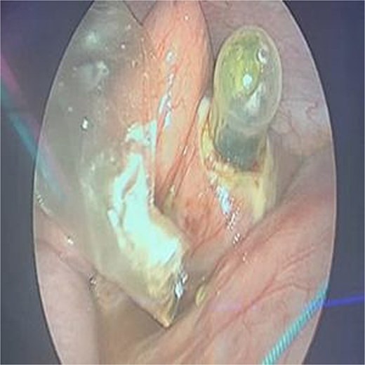 Extracted rubber nipple post-enterotomy.