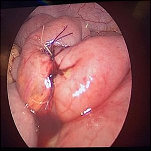 Closure of enterotomy site following foreign body removal.