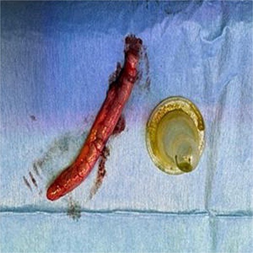 Resected appendix and retrieved foreign body.