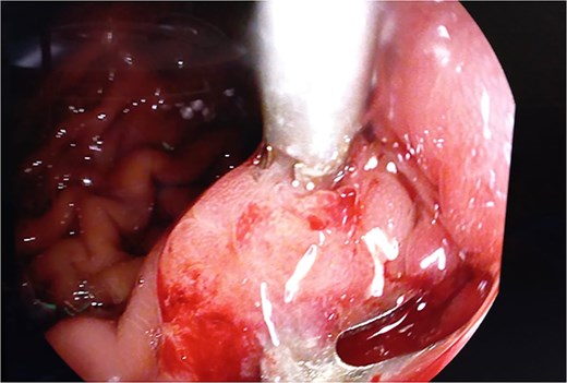 Intraoperative endoscopic view of pancreaticogastric fistula with previous endoscopic clip.