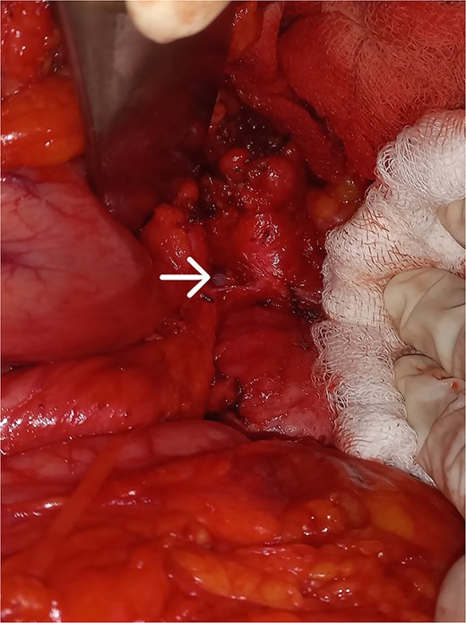 Pancreaticogastric fistula.
