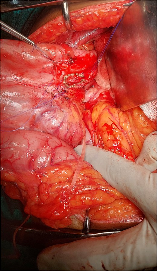 Stomach posterior wall cuff.