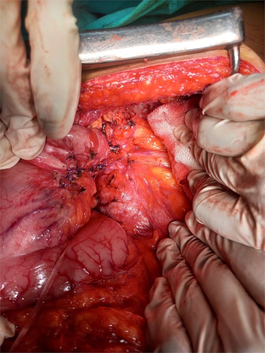 Gastric wall repair.