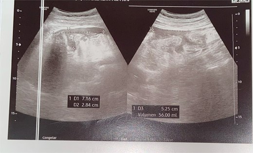Ultrasound revealing revealed a small amount of free fluid in the perihepatic, perisplenic, and right flank interloop regions.