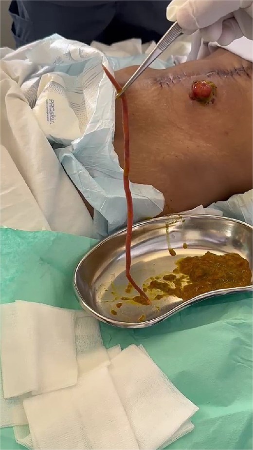 Ascaris lumbricoides extracted from ileostomy bag.
