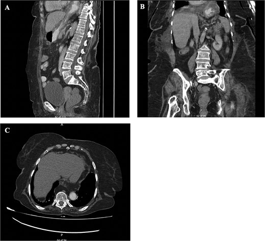 CT imaging showing large hiatal hernia with features of gastric volvulus.