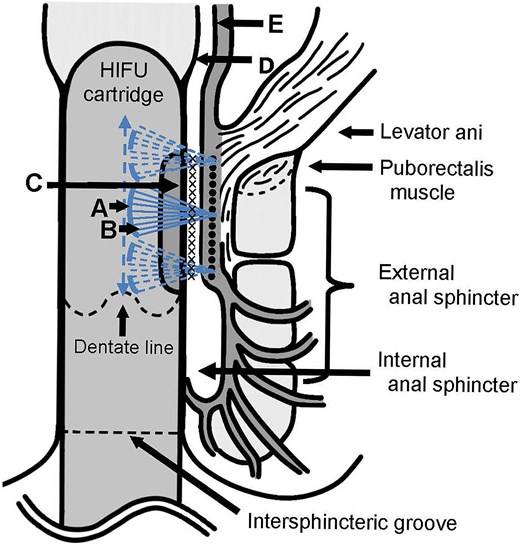 Schematic illustration of the delivery of HIFU. A focused transducer (A) with a curved surface emits ultrasound waves (B) through the vibrations of the piezoelectric materials. These waves are emitted from the emitting surface (C) of the HIFU cartridge and are focused on the irradiation site (×) (●). At a focal depth of 3.0 mm, the target was assumed to be the circular muscle and internal anal sphincter, whereas at a focal depth of 4.5 mm, it was thought to be the longitudinal muscle layer.