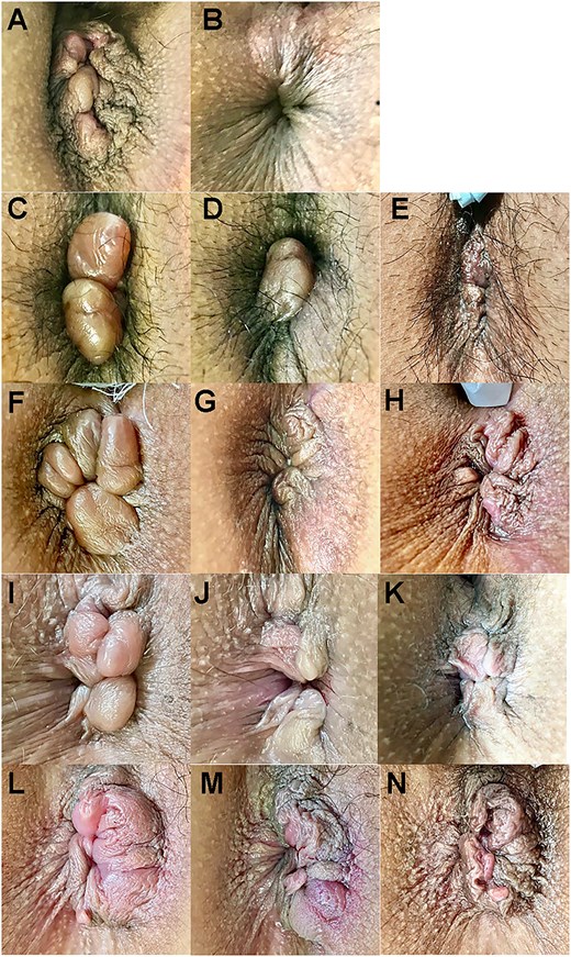 Longitudinal observation before and after HIFU rectoanal lifting (Cases 1–5). Top: Ventral. (A and B) Case 1 before and after HIFU (12 min). (C–E) Case 2 before and after HIFU (11 min) and 9 days later. (F–H) Case 3 before and after HIFU (9 min) and 19 days later. (I–K) Case 4 before and after HIFU (15 min) and 2 months later. (L–N) Case 5 before and after HIFU (16 min) and 15 days later. The numbers in brackets indicate the time elapsed since the photograph was taken before HIFU.
