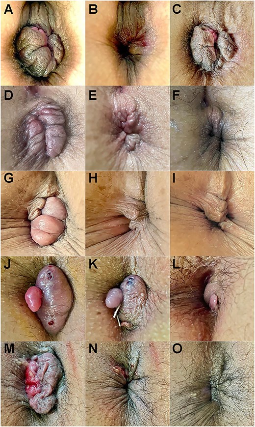 Longitudinal observation before and after HIFU rectoanal lifting (Cases 6–10). Top: Ventral. (A–C) Case 6 before and after HIFU (11 min) and 21 days later. (D–F) Case 7 before and after HIFU (15 min) and 3 months later. (G–I) Case 8 before and after HIFU (12 min) and 2 months later. (J–L) Case 9 before and after HIFU (20 min) and 2 months later. (M–O) Case 10 before and after HIFU (14 min) and 21 days later. The numbers in brackets indicate the time elapsed since the photograph was taken before HIFU.
