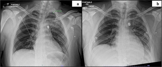 Preoperative imaging indicating the location of the projectile and image obstruction by metal artifact: Initial CXR (a), day 2 CXR (b).