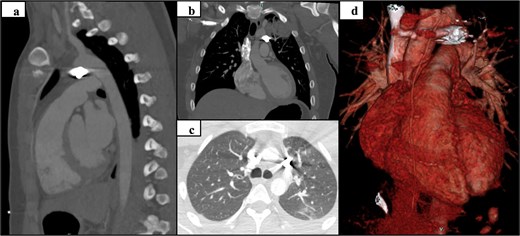 Preoperative CT and 3D reconstruction: sagittal (a), coronal (b), axial (c), and 3D reconstruction (d).