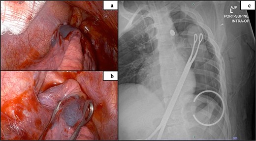 Intraoperative mediastinum adhesion visualized via robot (a), isolated upper lobe suspicious of containing bullet remnant (b) and intraoperative radiograph confirming bullet localized in the mediastinum (c).