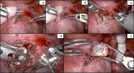 Incision of the mediastinal pleura (a), initial visualization of the bullet (b), dissection of the pleura (c), removal of the bullet (d), and confirmation of no bleeding with the bullet removed (e).