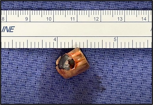 Removed bullet foreign object.