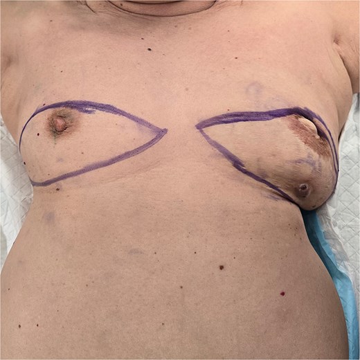 Preoperative picture of bilateral breasts.